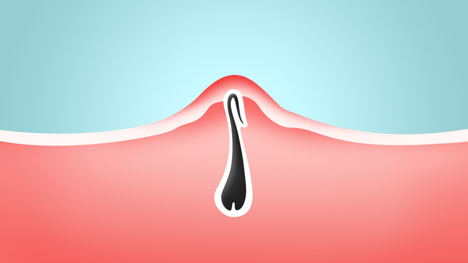 Dos and Donts For Handling Your Ingrown Hairs